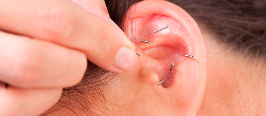 Ušní akupunktura - aurikuloterapie Ušní akupunktura - aurikuloterapie